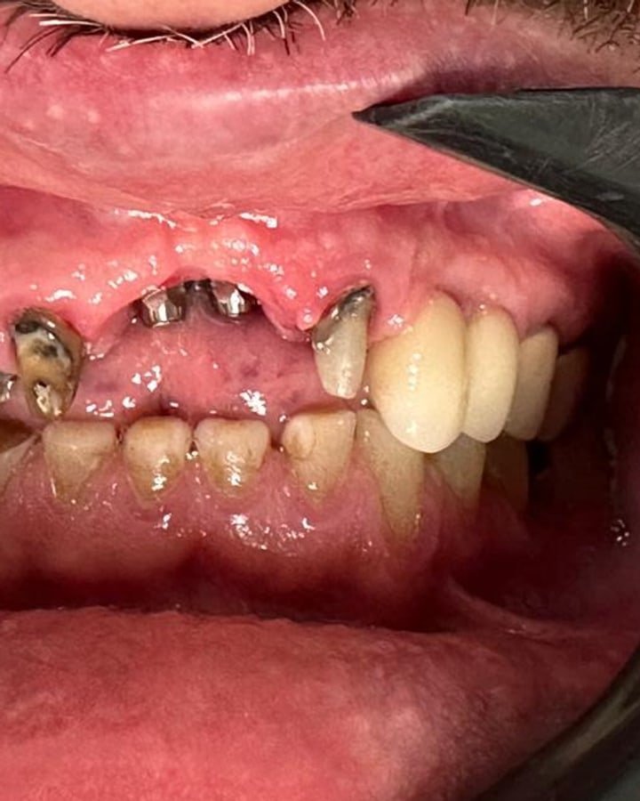Antes, implante dentário