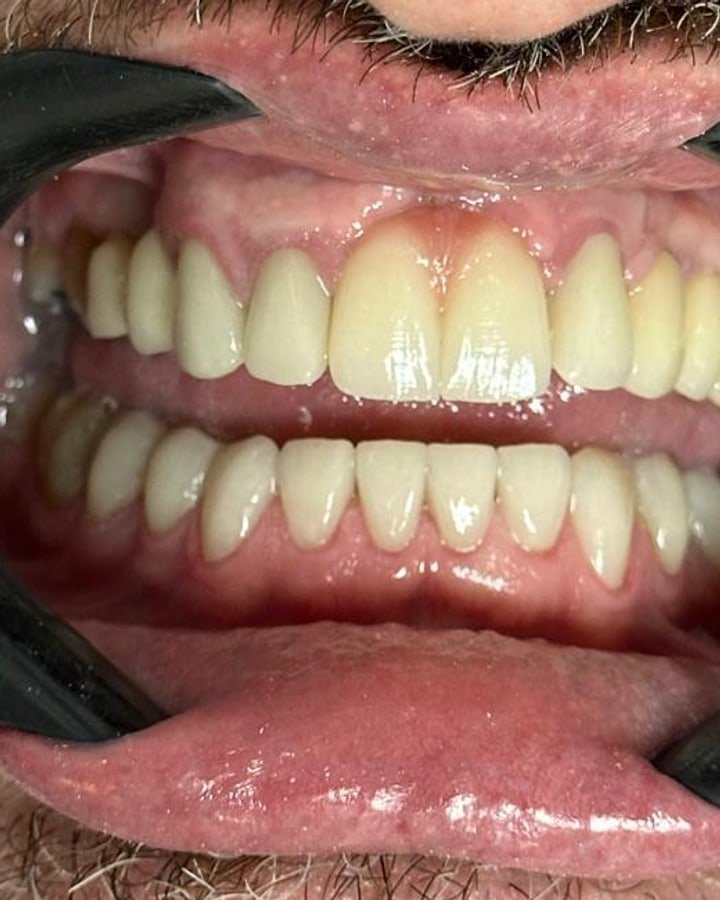 Depois, implante dentário